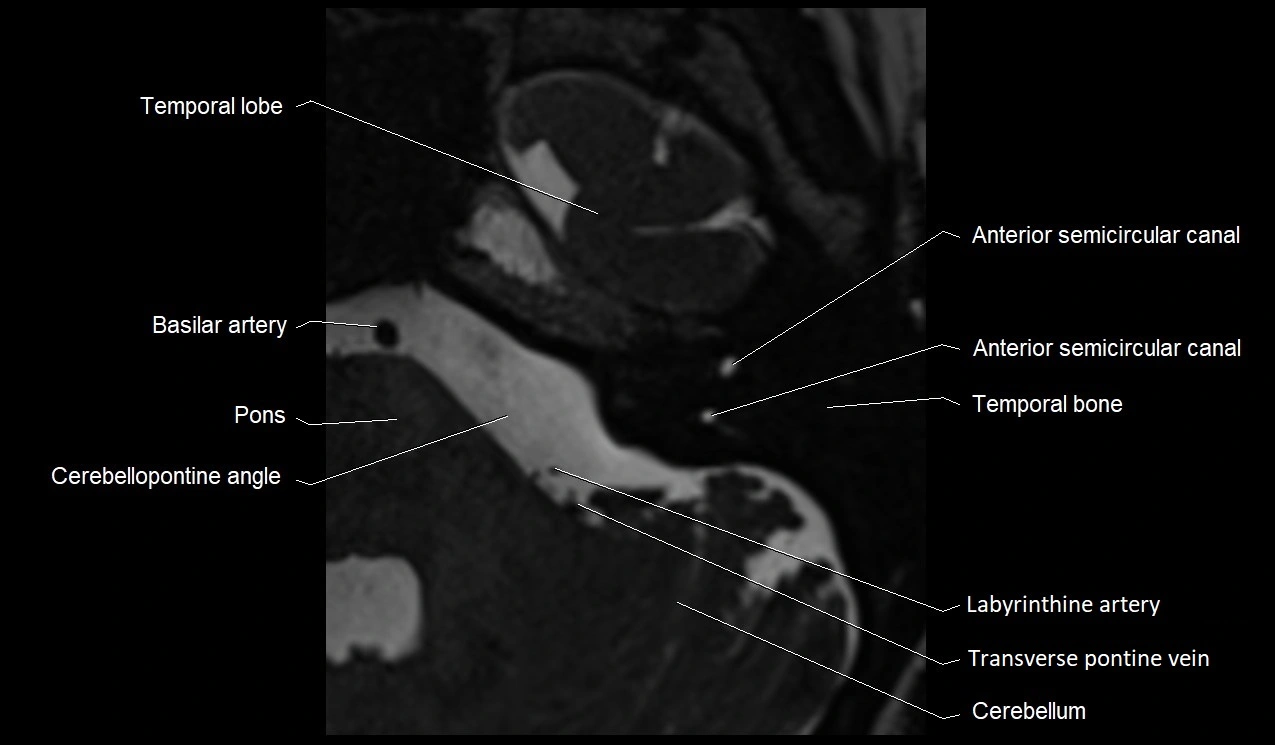 Internal auditory canal (IAC) axial cross sectional anatomy image 20.webp